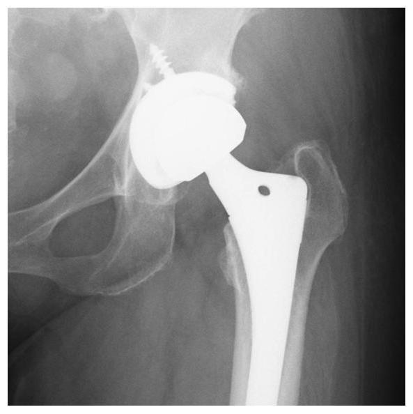 図３ 人工股関節置換術